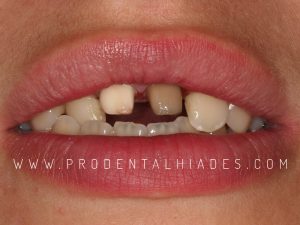 preparación de dientes 11 y 21