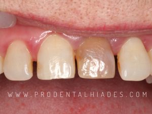 Diente 21 oscurecido