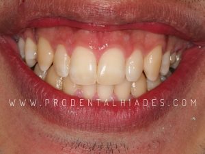 sonrisa amplia