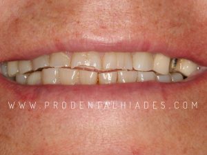 dientes desgastados