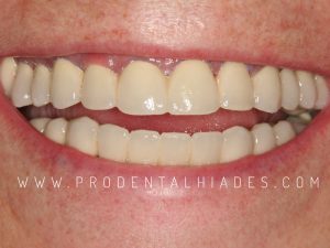 prótesis fijas terminadas