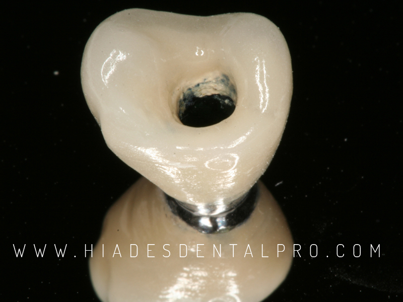 Corona metal-cerámica sobre implante en Prodental hiades