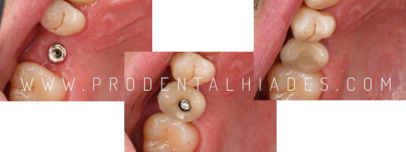férula antirronquidos - Clínica Dental Prodental Híades
