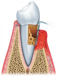 periodonto