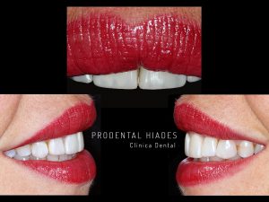 Carillas sobre lámina de platino